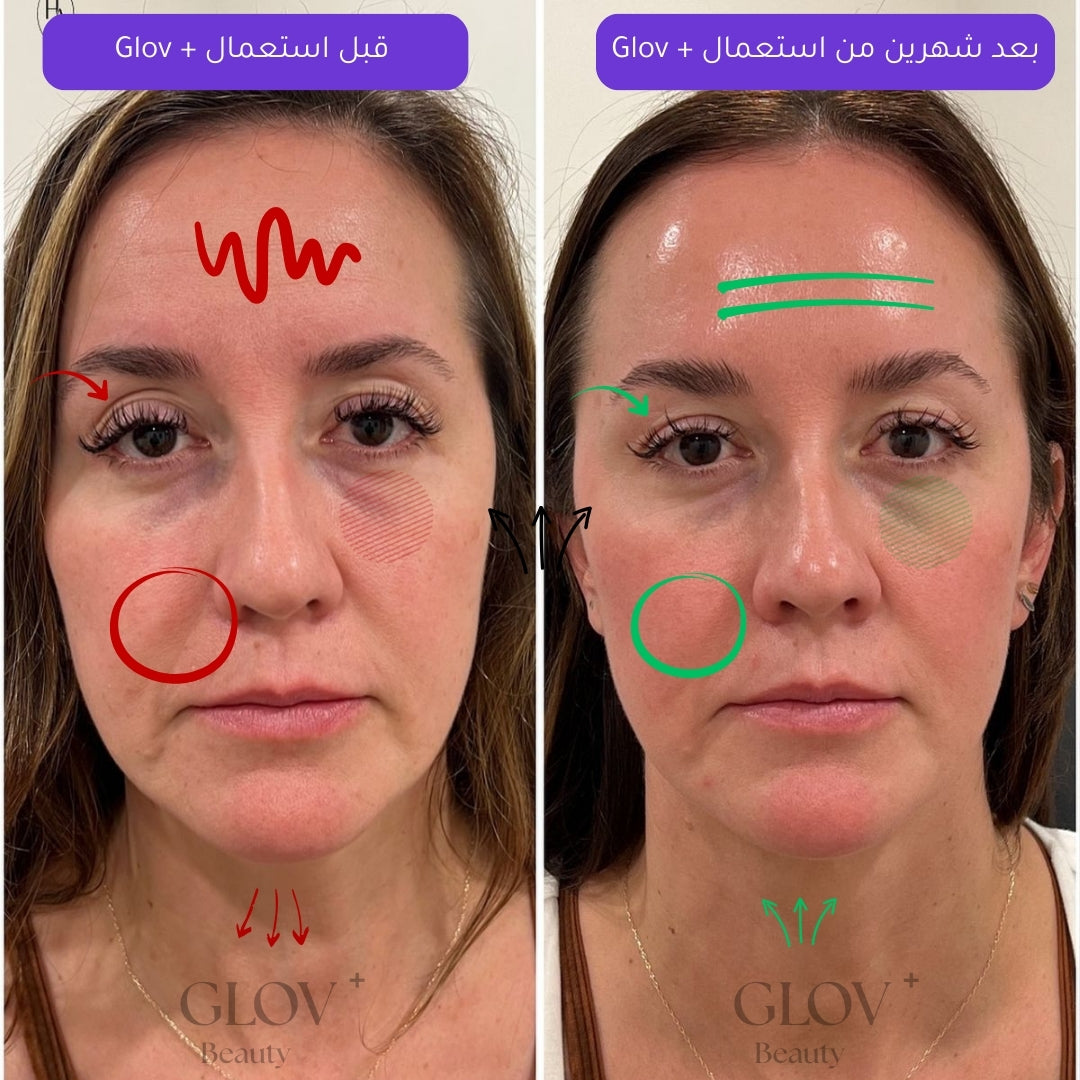 Glov+ | سيروم علاجي بتقنية مايكرو إنفيوجن لتجديد البشرة