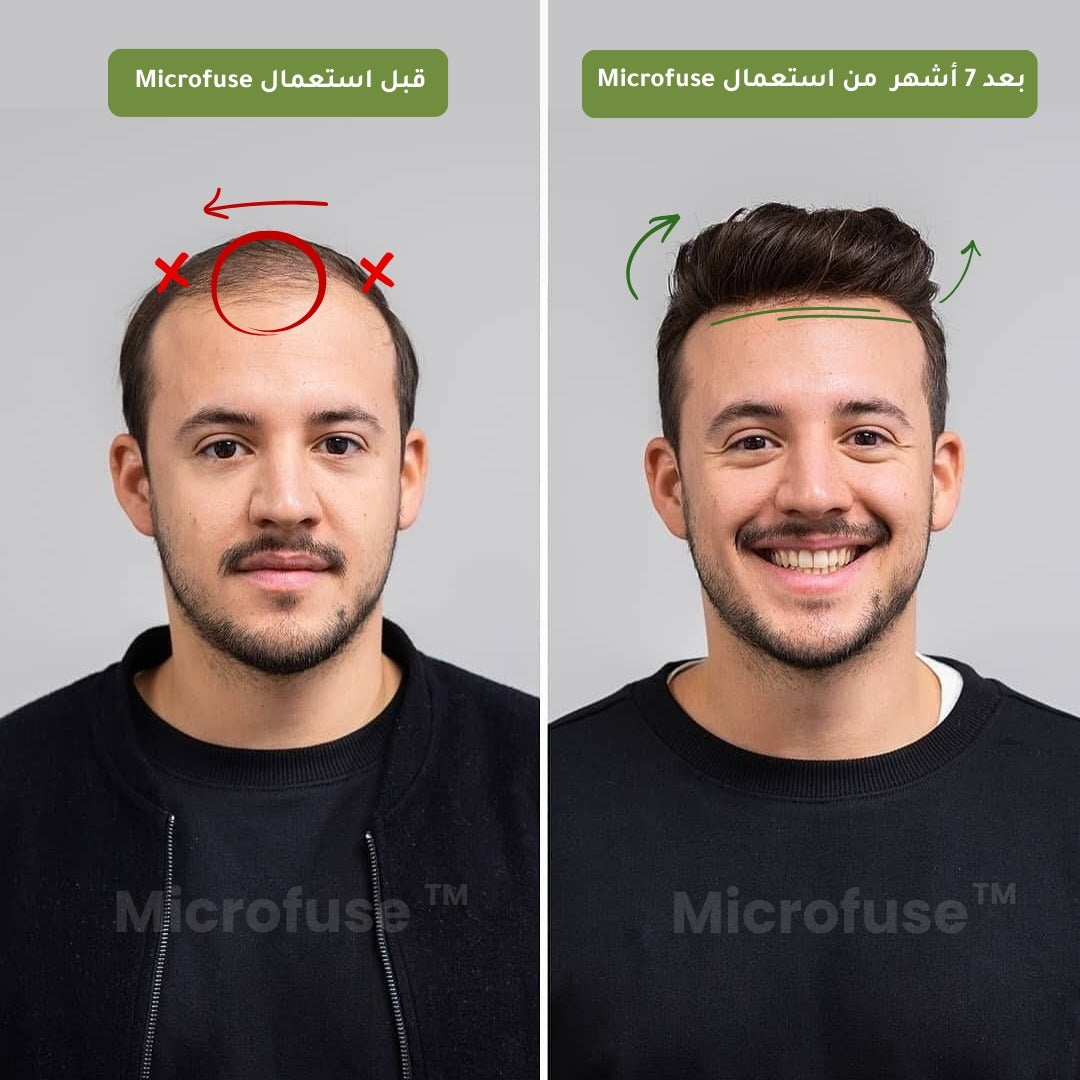 Microfuse™ | علاج طبي مطوّر لتعزيز نمو وكثافة الشعر من الجذور