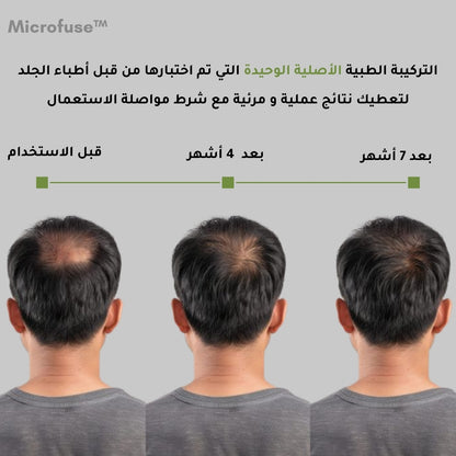 Microfuse™ | علاج طبي مطوّر لتعزيز نمو وكثافة الشعر من الجذور