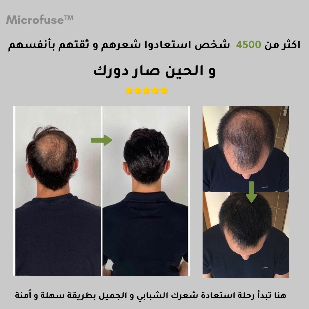 Microfuse™ | علاج طبي مطوّر لتعزيز نمو وكثافة الشعر من الجذور